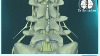 عمل جراحی لامینکتومی کمری  جهت درمان تنگی کانال کمر