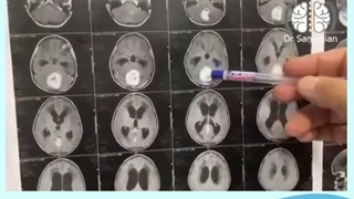 عمل جراحی تومور مخچه