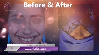 بلافاصله بعد از جراحی بینی