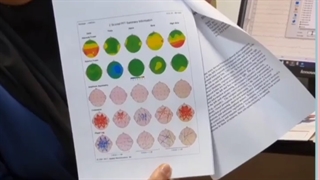 رضایت درمان آرتی ام اس