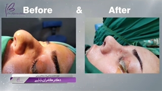 بلافاصله بعد از عمل بینی گوشتی