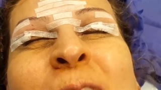 جراحی پلک فوقانی و ابرو