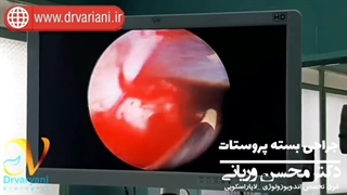 جراحی بزرگی خوش خیم پروستات به روش بسته -قسمت دوم