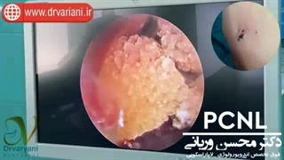 جراحی سنگ کلیه در یک بیمار ۱۲ ساله از کشور عراق