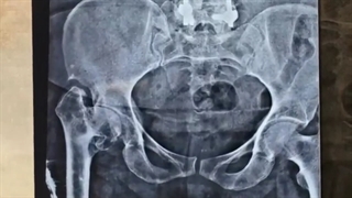 جراحی تعویض مفصل لکن