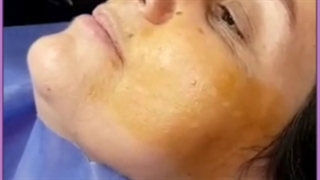 معرفی ۱۱ روش مدرن و معجزه گر لیفت صورت