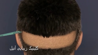 بهترین روش کاشت مو