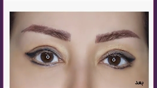 هزینه، روش ها و مزایای لیفت چشم بدون جراحی