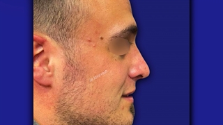 سه هفته پس از جراحی زیبایی بینی | دکتر خوروش