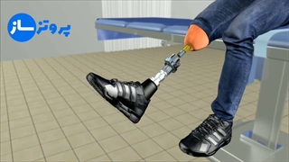 کاشت پای مصنوعی - نحوه کاشت پای مصنوعی به روش ایمپلنت | پروتز ساز
