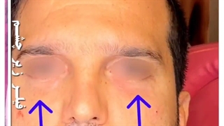 تغییرات قبل و بعد از فیلر زیر چشم