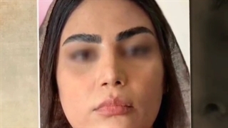 تزریق فیلر چانه