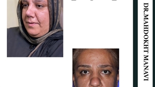 جراحی بینی گوشتی مراجع کننده عزیز ۳ هفته بعد از عمل