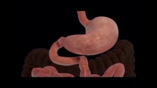 جراحی بای پس معده