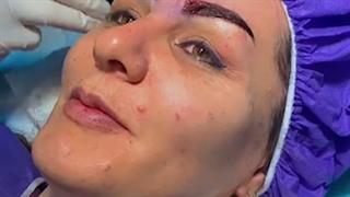 فیلم حین انجام عمل کاشت ابرو