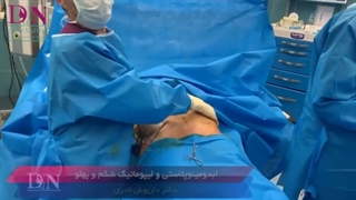 ابدومینوپلاستی و لیپوماتیک به صورت همزمان