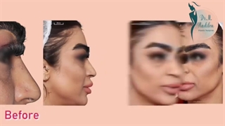 نمونه ای از جراحی رینوپلاستی