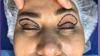 هزینه عمل جراحی افتادگی پلک (بلفاروپلاستی) چقدر است ؟