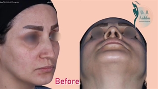 نمونه واقعی و بدون فتوشاپ جراحی بینی