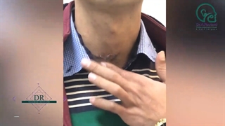 درمان اختلال تکلم و بلع