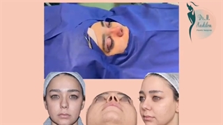 جراحی بینی را از نزدیک ببنید!