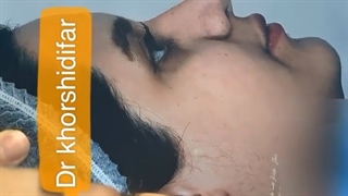 نتیجه جراحی رینوپلاستی بدون برش پره های بینی
