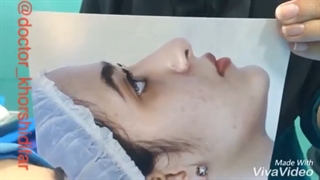 نتیجه جراحی زیبایی بینی