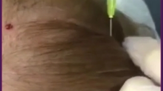 جلوگیری از ریزش مو _راهکارهای موثر در درمان ریزش مو