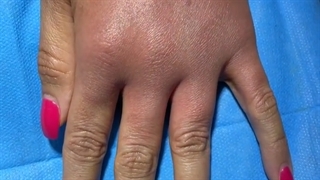 نمونه کار تزریق چربی به دست در کلینیک دکتر لاغری عمل زیبایی