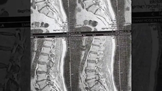 آقای 60 ساله با درد شدید کمری