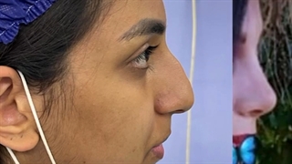 رضایت پس از عمل بینی