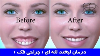 درمان لبخند لثه ای و جراحی فک | دکتر احسان ابوئی مهریزی
