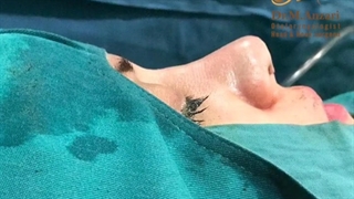 فیلم بدون سانسور اتاق عمل همزمان بینی و بلفاروپلاستی