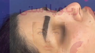 نمونه ای از رینوپلاستی بدون سانسور