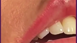 آنچه در مورد تزریق ژل نمی دانید