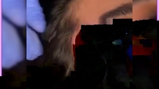 لیفت ابرو بدون جراحی چیست ؟ هزینه، روش ها و مزایای هر کدام