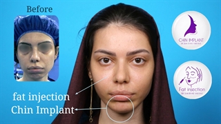 ایمپلنت چانه و تزریق چربی صورت | دکتر یحیوی