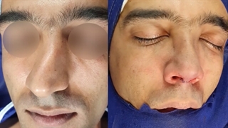 قبل و بعد عمل بینی بسیار کج | دکتر طاهریان