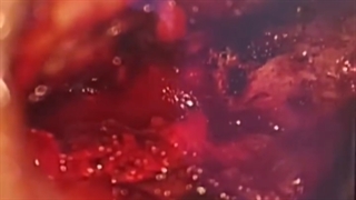 بیمار خانم جوان با دیسک اکسترود L5-S1