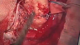 مننژیومای بزرگ فلکس(داس مغزی)