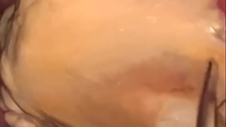 جرمگیری دندان