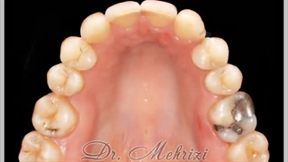 درمان با بستن فضای دندانهای غایب | دکتر احسان ابوئی مهریزی