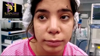 ترمیم افتادگی پلک بالا که توسط پزشک دیگه ای یکسال پیش انجام شده بود