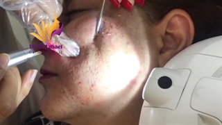 فیلم تخلیه غدد چربی صورت