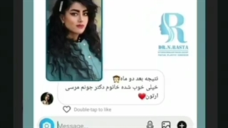 نتیجه جراحی زیبایی بینی بعداز دوماه