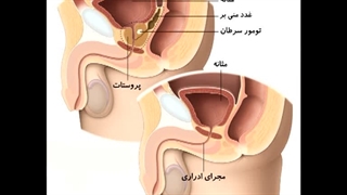 بررسی آناتومی پروستات به منظور درک بهتر نحوه جراحی در سرطان پروستات