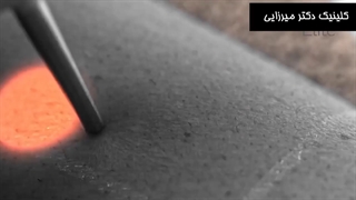 لیزر الکساندرایت سایناشور الیت پلاس