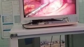 جراحی آپاندیس حاد و چرکی