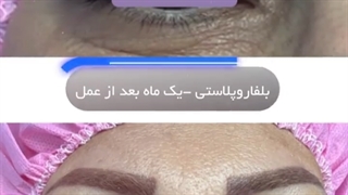 بلفاروپلاستی پلک