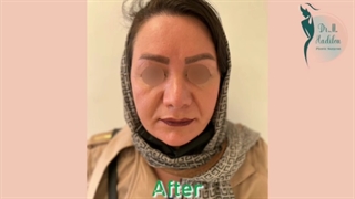 نمونه ای از فیلم واقعی عمل زیبایی بینی در تهران